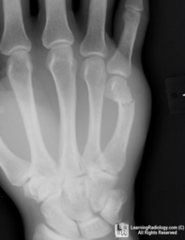 <p>fracture of the neck of the 5th metacarpal</p>