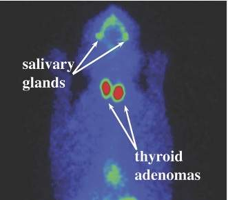 <p><span>Ectopic thyroid tissue in chest, highlighted in green. </span></p><p><span>Identifying areas of extra-thyroid tissue useful when determining treatment option</span></p>