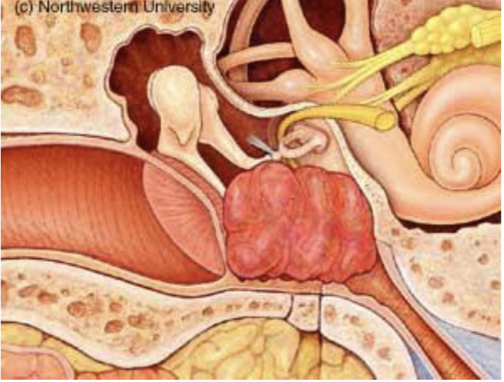 <p>a tumor that is not malignant, is very slow growing, and can disrupt the ossicular chain (needs surgical removal)</p><p>patients complain that they can hear their heartbeat in their ear </p>