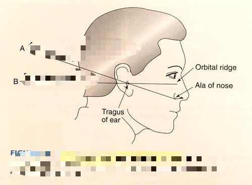 <p>line a is what extraoral landmark?</p>