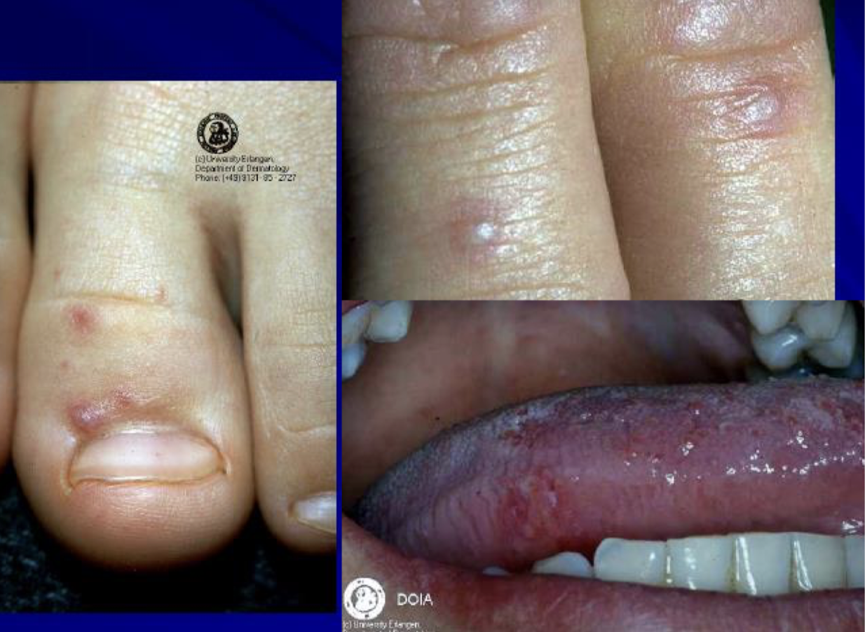 <p>what are these lesions associated with</p>