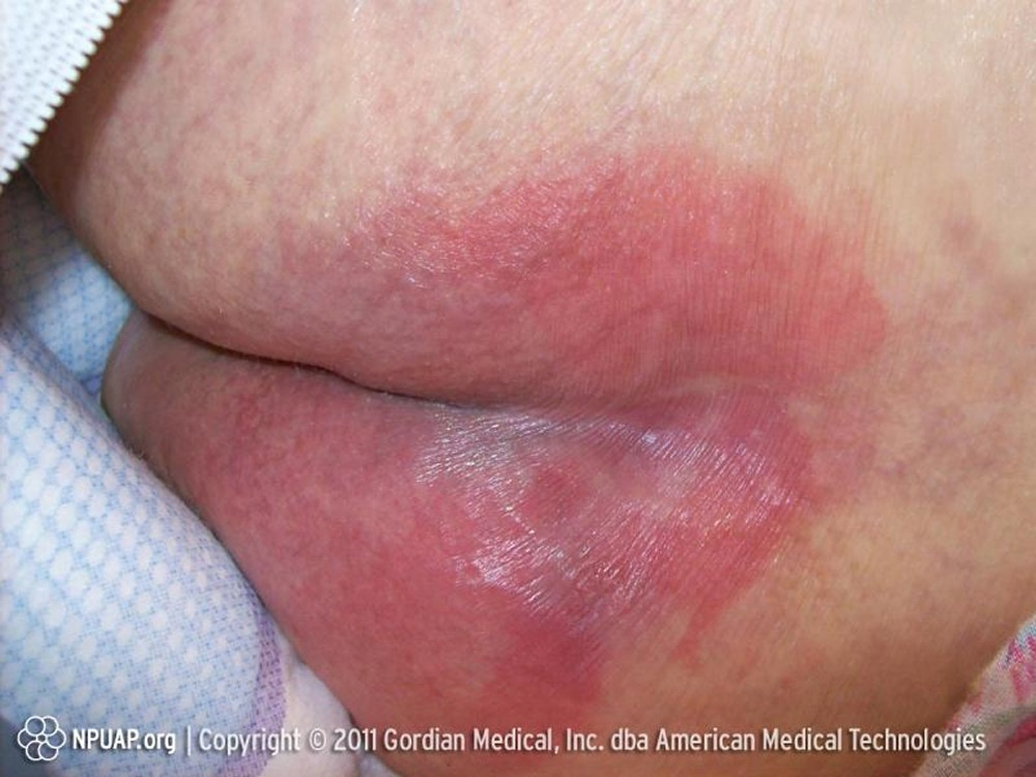 <p>What pressure sore does this depict?</p>
