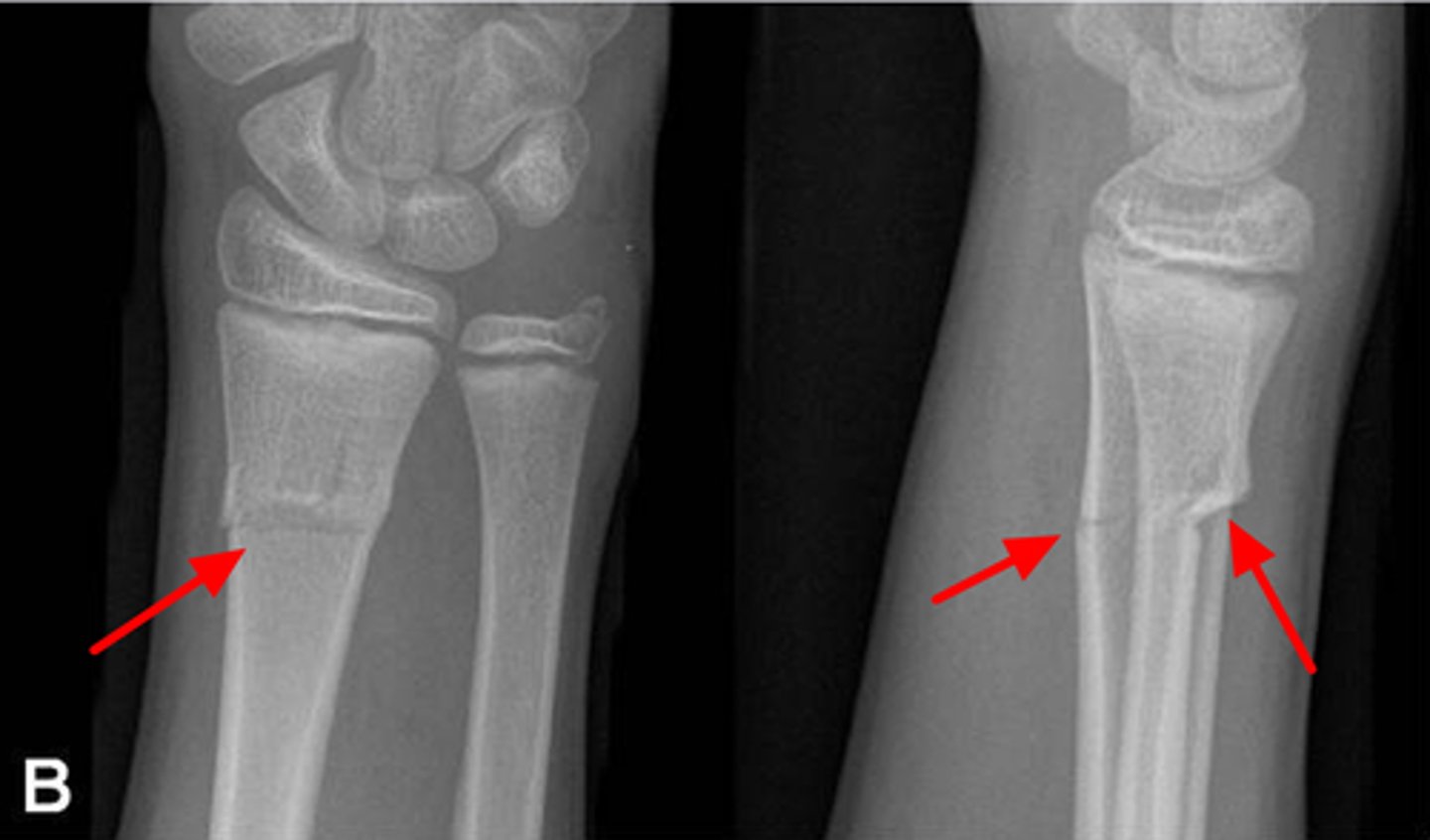 <p>fracture w/o a cortical break</p><p>-looks like a bone that buckles in on itself; a telescope</p><p>-more common in children</p>