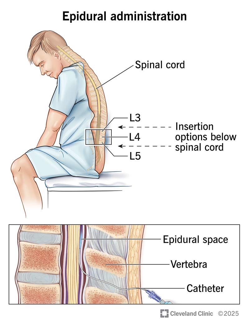 <p>Epidural space (spine) (injectable liquid)can't administered</p>