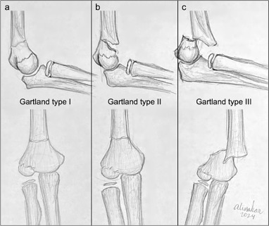 <p>Non displaced treat cast 3-4 weeks -xray at 1 week </p><p></p>