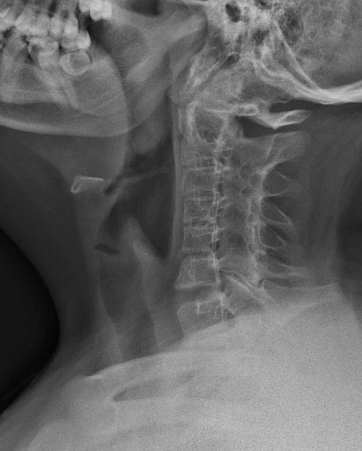 <p>This adult patient who had JCA presents what findings</p>