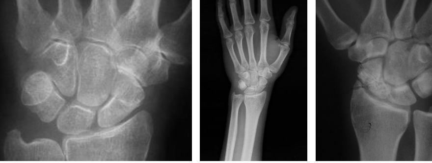 <p>px llega con dolor en la tabaquera anatomica y ligera tumefaccion de la mano</p>