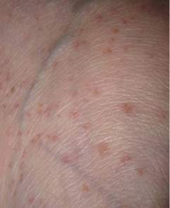 <p>hyperkeratosis lenticularis perstans</p><p><span>keratotic papules on the lower legs</span></p>