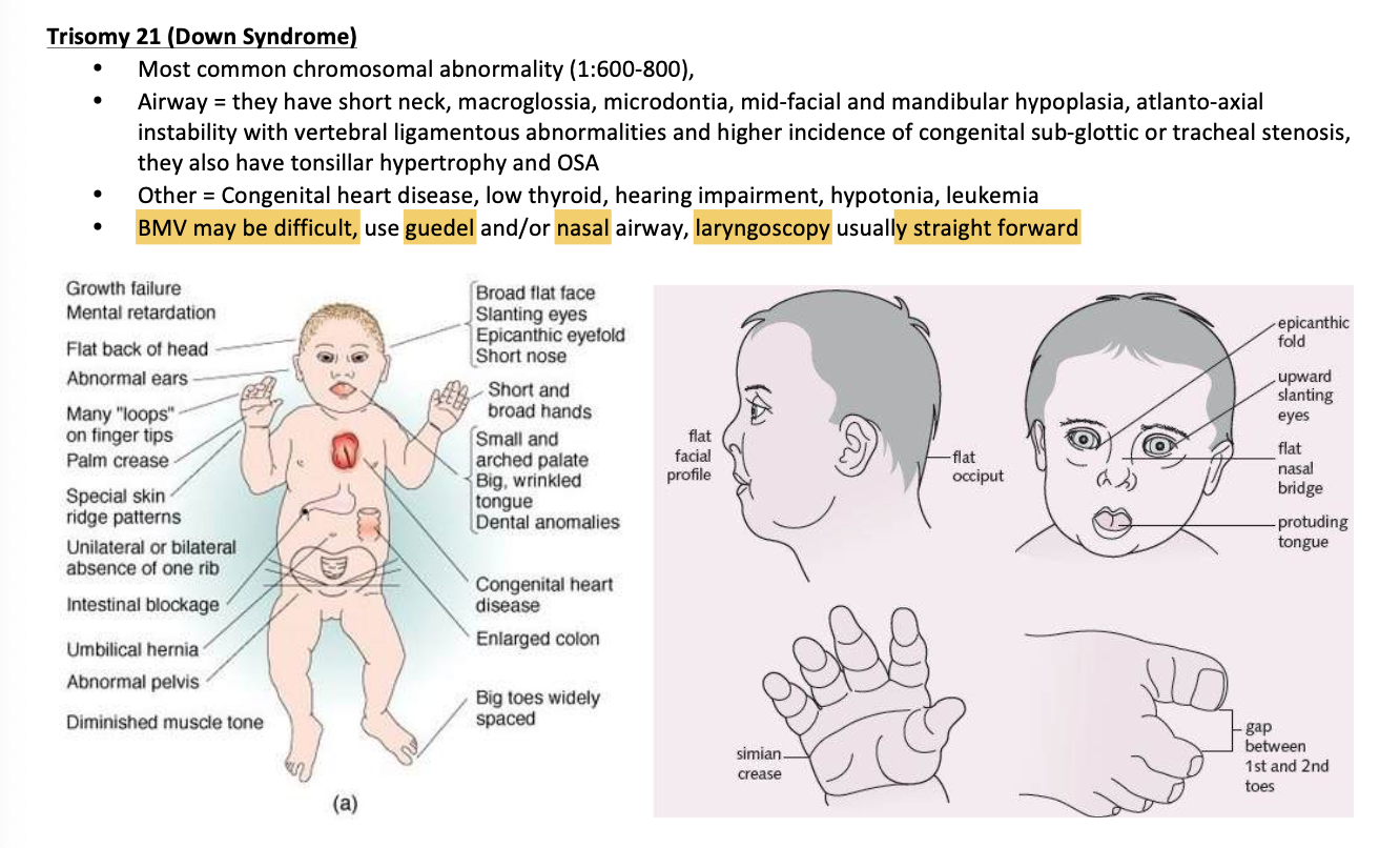 <p>Most common 1:600-800</p><p></p><p>Airway</p><ul><li><p>Short neck</p></li><li><p>Macroglossia</p></li><li><p>Microdontia</p></li><li><p>Mid-facial and mandibular hypoplasia (underdeveloped)</p></li><li><p>Tonsillar hypertrophy</p></li><li><p>Atlanto-axial instability</p></li><li><p>Vertebral ligamentous abnormalities </p></li><li><p>Higher incidence of congenital sib-glottic or tracheal stenosis</p></li></ul><p></p><p>OSA too</p><p></p>