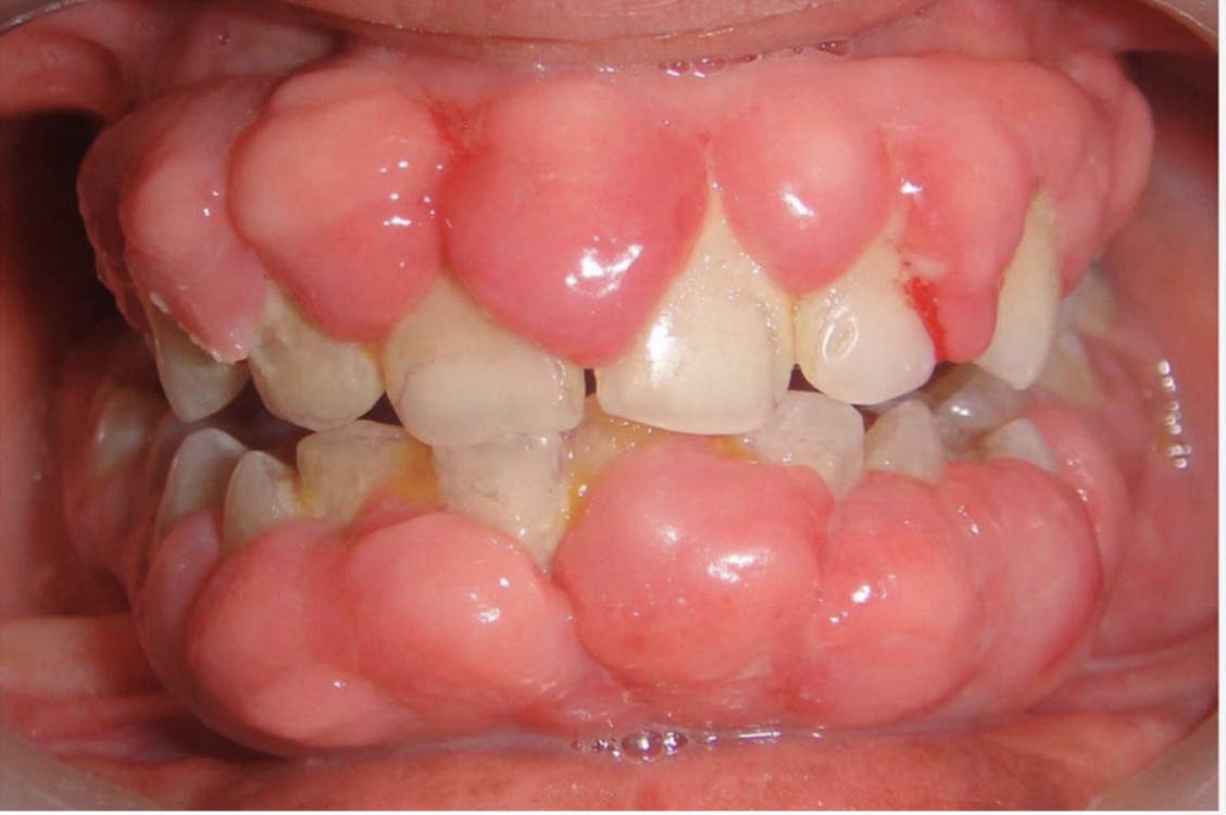 <p>BN CÓ GAI NƯỚU TĂNG SINH, SƯNG TO, CẮNG BÓNG</p><p>SỜ DAI, KHÔNG ĐAU, KHÔNG CHẢY MÁU *</p><p>CHẨN ĐOÁN</p>