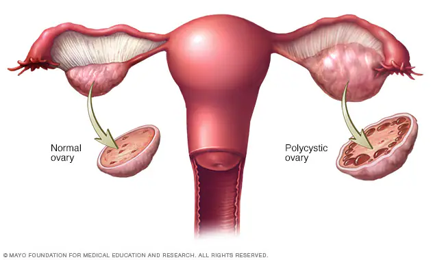 <p>A <strong>hormonal disorder</strong> in which the <strong>ovaries produce excess male hormones</strong>, causing <strong>irregular periods, cysts in the ovaries, and fertility problems</strong>.</p>