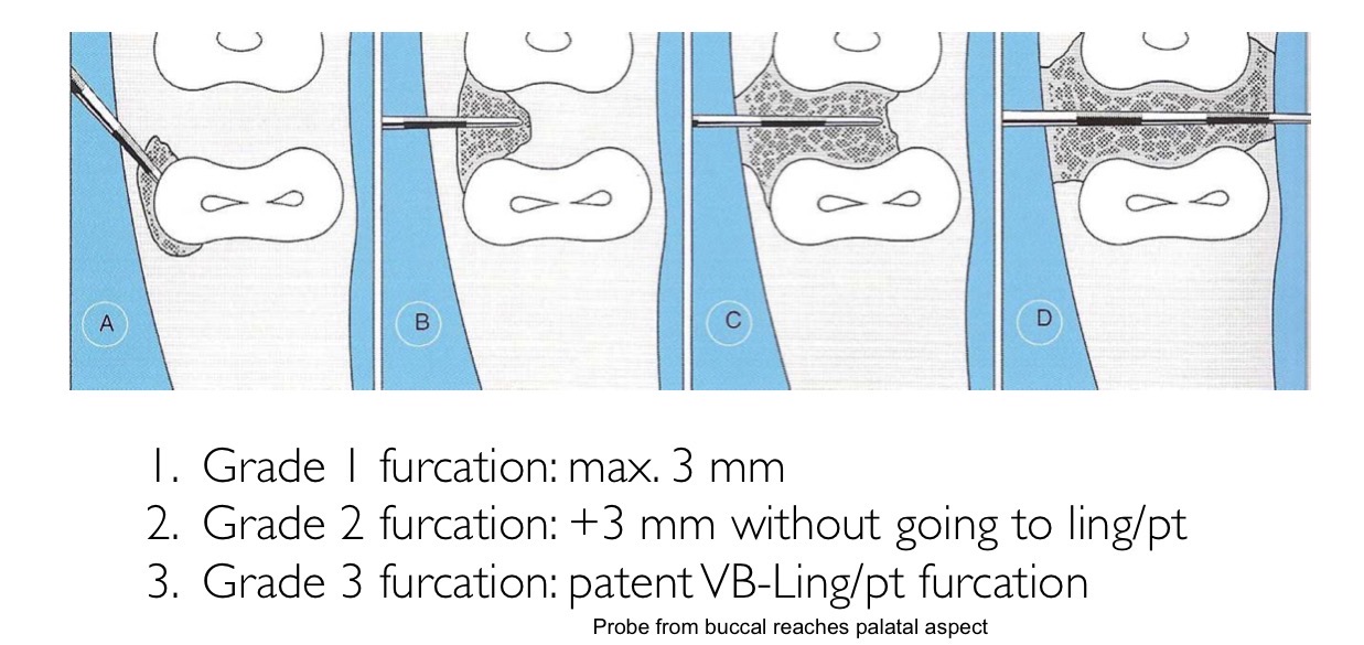 <p>Grade 1- up to 3mm</p><p>2- over 3mm without passing through PT</p><p>3- through and through </p>