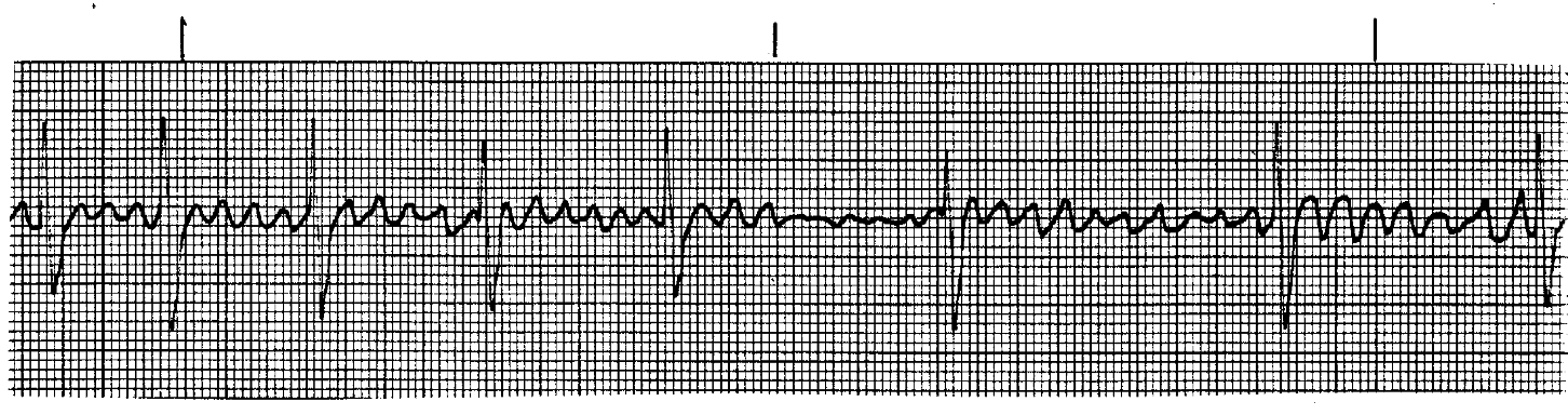 <p>What ECG is this>? </p>