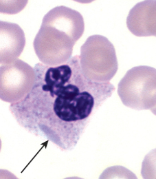 <p>What is the classification, cause, and morphology of may-hegglin anomaly?</p>