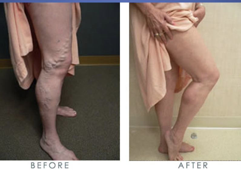 <p>-Laser or radio frequency</p><p>-Heated catheter creates scare tissue and causes vein to close</p><p>-treats <span>varicose veins and chronic venous insufficiency</span></p>