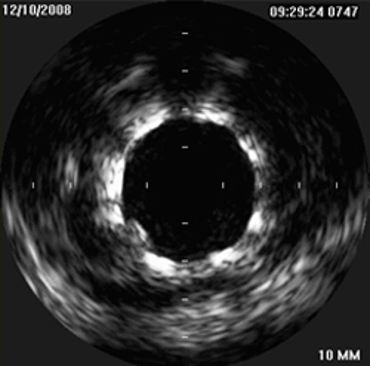 <p>This stent is fully apposed</p>