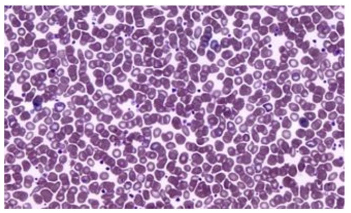 <p>Polycythemia of a male </p>