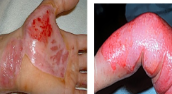 <p>2nd degree burn (deep partial thickness) findings*</p>
