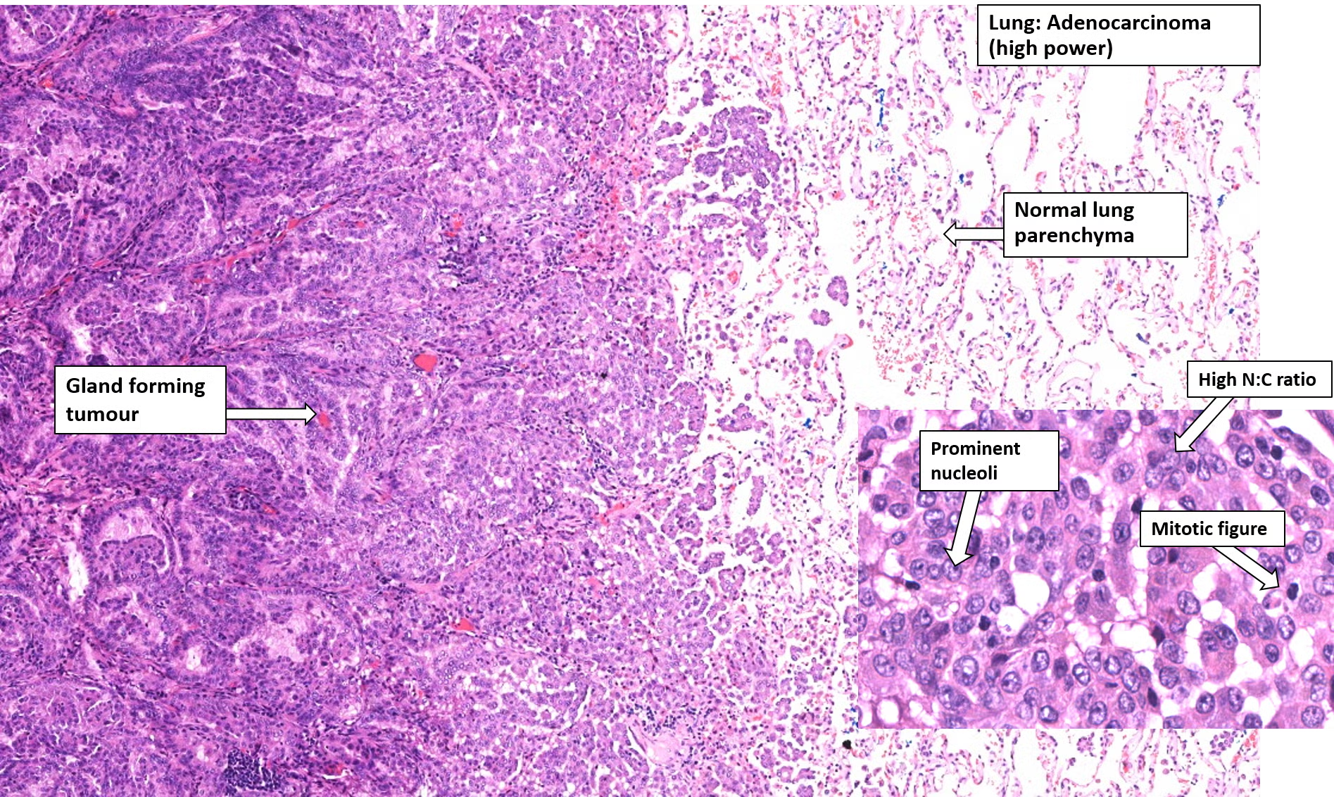 <p>Adenocarcinoma </p><p>(non-small cell)</p>
