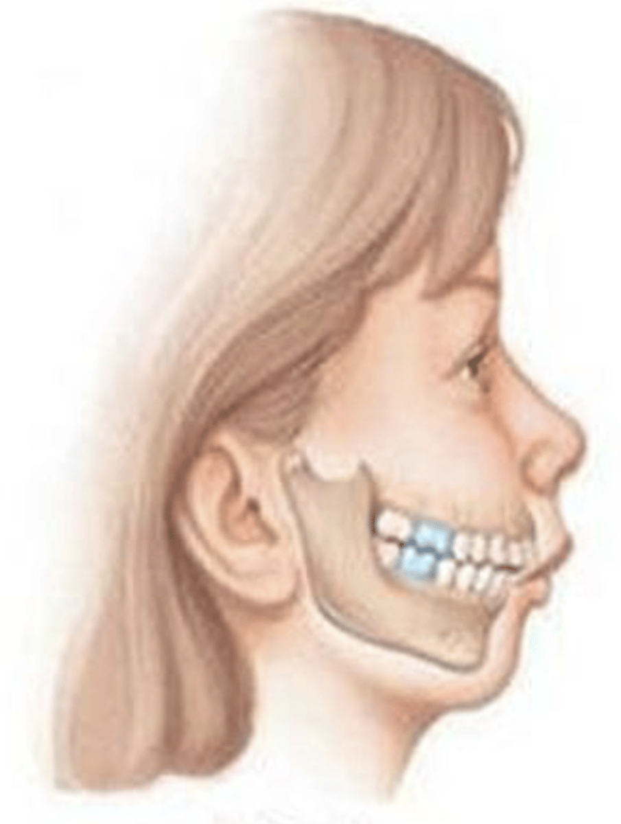 <p>ID the occlusal classification:</p>