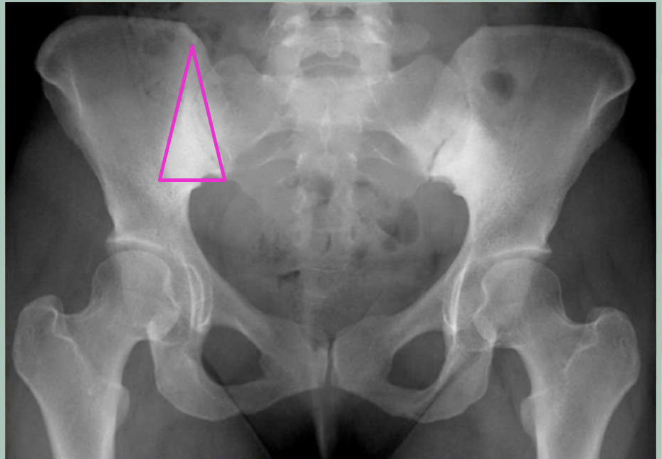 <p>Osteitis Condensans Ilii (OCI)</p>