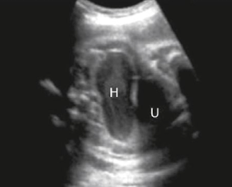 <ul><li><p>obstruction of uterus and vagina resulting in collections of fluid (hydrometrocolpos)</p></li><li><p>from atresia/blockage of vagina or cervix, imperforate hymen, or abnormal membranes within vaginal lumen</p></li><li><p>masses may be predominantly cystic, may contain midlevel echoes, or may be fluid-debris levels</p></li><li><p>SONO: hypoechoic “cyst-like” ovoid mass posterior to bladder in area of uterus</p></li></ul><p></p>