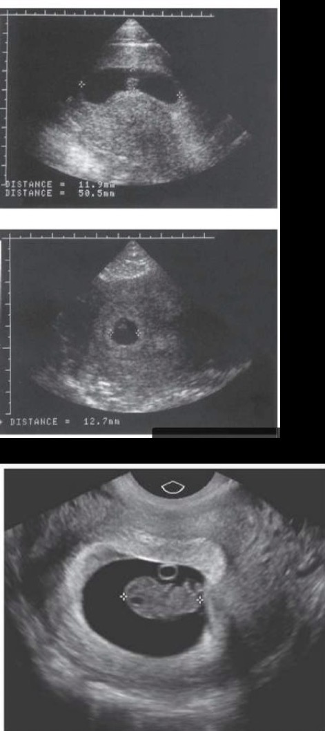 <p>Measured from top of head (crown) to middle of buttocks (rump); anechoic area is rhombencephalon; provides most accurate date for pregnancy</p>