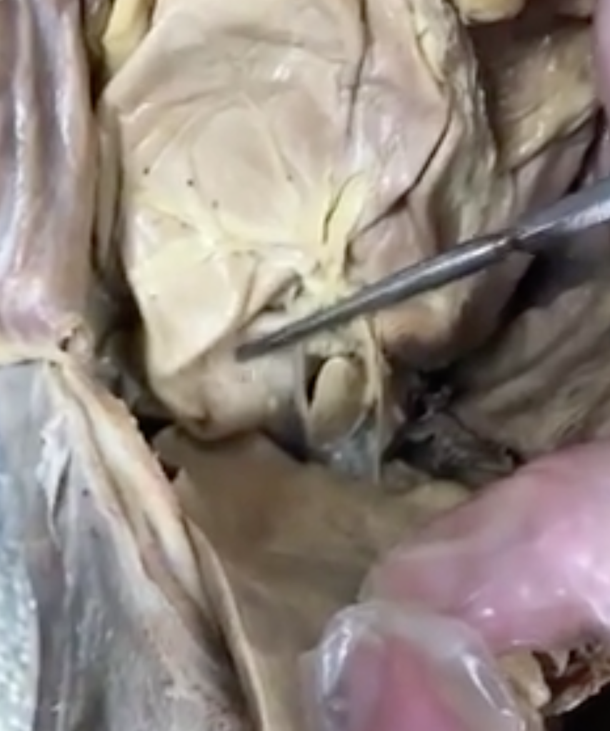 <p>what region of the stomach is prong pointing to</p>