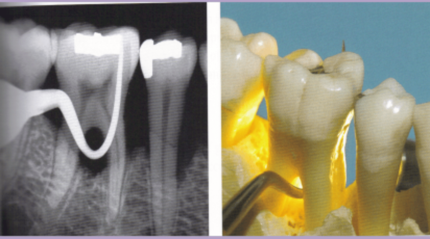 <p>bone loss through and through</p><p>clinically can see</p><p>radiographic evidence</p>