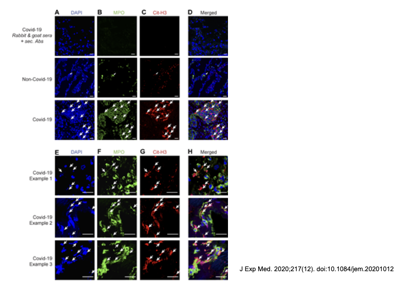 <p>use antibodies to look at the MPO and look at localization</p><p>trap= localization</p><p>MPO released by NETs</p>