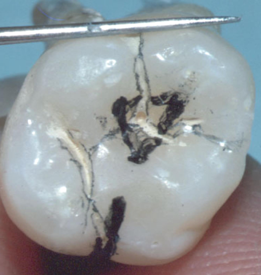 <p>Maxillary molar access</p>