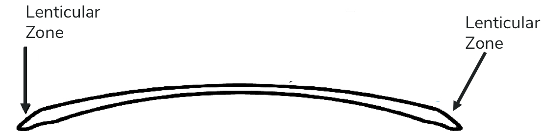 <p>A peripheral curve on the front of the lens that decreases the edge center thickness</p>