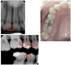 <p>What is the treatment for #3?</p><p>Findings:</p><p>- Visual: Occlusal-Broken amal-Mesial-Adv.</p><p>- Radiographic: M - Advanced</p>