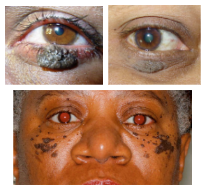 <p>What is the most likely diagnosis ?</p>