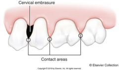 <p>Occurs when there is gingival recession between teeth, and the interproximal papilla and bone no longer fill the entire interproximal space.</p>