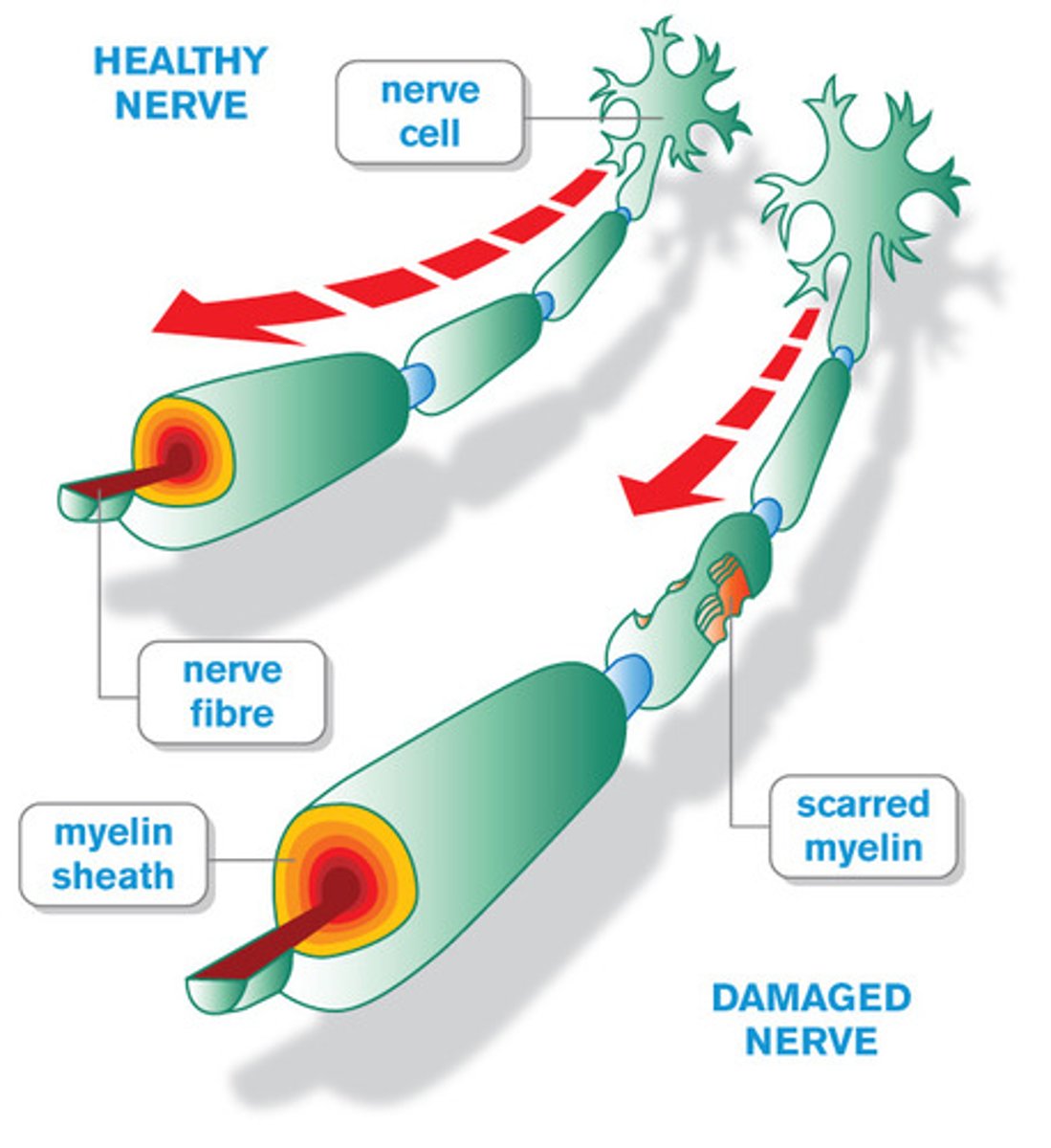 <p>A disease in which the myelin sheath is attacked by the patient's own immune system. This causes slower nerve impulse speeds and sometimes leads to a short circuit of the impulse.</p>