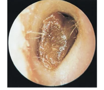 <p>odee ear wax</p>