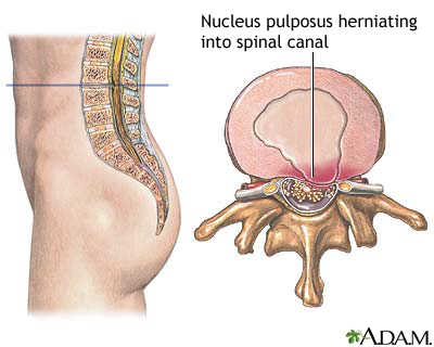 <p>Which spinal nerve is affected during a small HNP?</p>