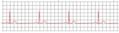 <p>The nurse is caring for a client who reports feeling faint and is experiencing the cardiac rhythm shown in the electrocardiogram (ECG) strip below. </p><p>Which of the following actions would be appropriate for the nurse to take? Select all that apply. </p><p>1. Administer the client's prescribed beta blocker. </p><p>2. Prepare for transcutaneous pacing. </p><p>3. Instruct the client to perform the Valsalva maneuver. </p><p>4. Begin chest compressions. </p><p>5. Assess the client for angina.</p>