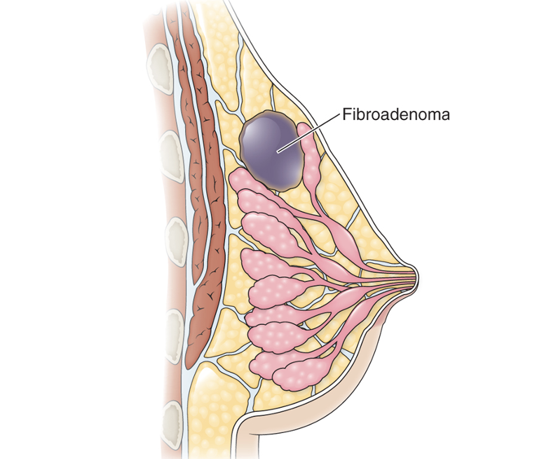 <p><span><strong>Fibroadenoma</strong></span></p>