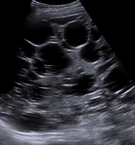 <p>It is 80-90% of PLD where cysts are present in both the liver and kidney</p>