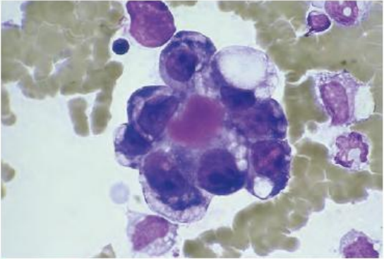 <p><strong><u>Ascitic Fluid Cells: Peritoneal Fluid</u></strong></p><ul><li><p>Showing <span style="color: yellow;">community borders (Cytoplasmic molding)</span> , nuclear irregularity and hyperchromatic nucleoli </p></li></ul><p></p>