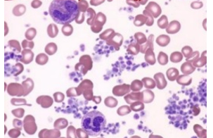 <p>Thrombocytosis </p>