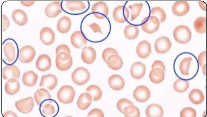 <p>What abnormal RBC shape is shown? </p>
