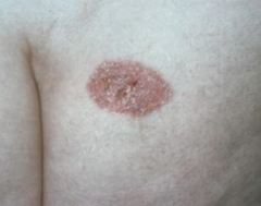 <p>Risk Factors:</p><p>-Age/Sex (common in elderly males)</p><p>-History of SCC or other skin cancers (BCC, MM)</p><p>-fair skin, blue eyes, blonde/red hair (FP I-III)</p><p>-h/o of smoking</p><p>-previous trauma to the area</p><p>-inherited syndroms (ex. albinism)</p><p>-exposures: ionizing radiation</p>
