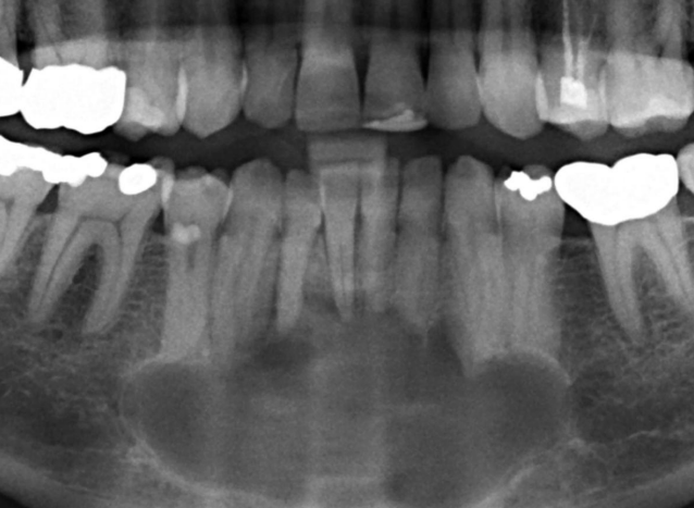 <p>A 35-year-old woman presented with the chief complain of asymptomatic swelling in the lower front region of jaw since 4 months. On clinical examination, hard swelling was present on body of mandible in relation to 33 to 43, obliterating the buccal vestibule and measuring about 1.5 cm in diameter. On palpation, the lesion was nontender, with no discharge, and the overlying mucosa was normal. Provide DD</p>