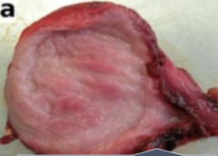 <p>How would you classify this chronic cystitis pattern?</p>
