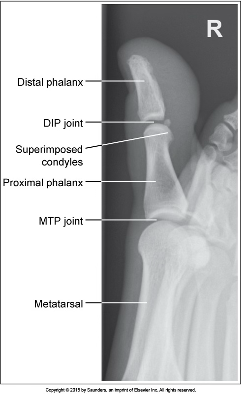 <p>lateral toe</p>