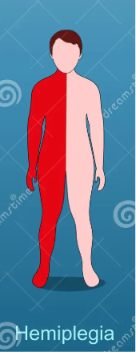 <p><span style="background-color: transparent;"><strong>Complete or partial side of the body is paralyzed</strong></span></p>