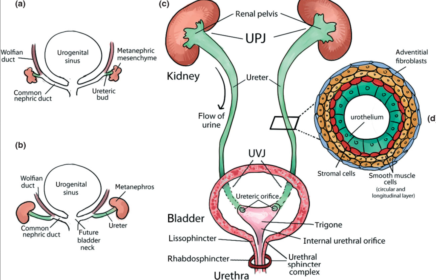 <p>- urethral obstruction</p><p>- congenital</p>